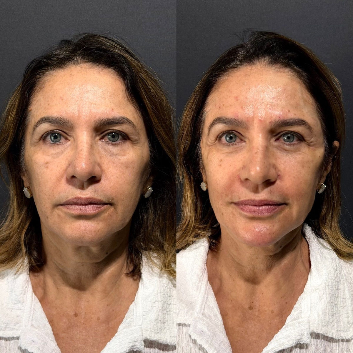 Caso rejuvenescimento